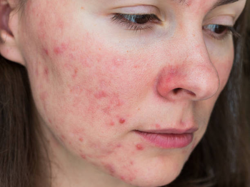 Close-up of a Caucasian woman's face showing acne and blemishes on her cheek and chin.