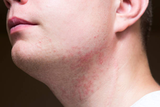 Close-up of a man experiencing a skin condition on his neck.